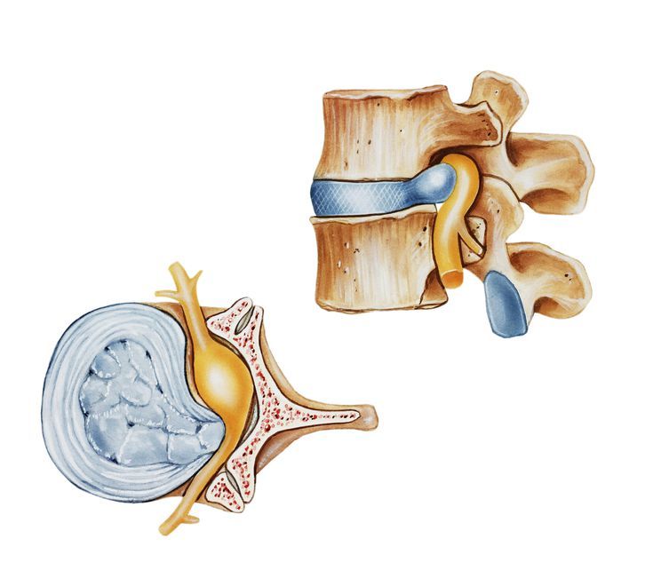 Hernia discal como causa de dolor de ciática